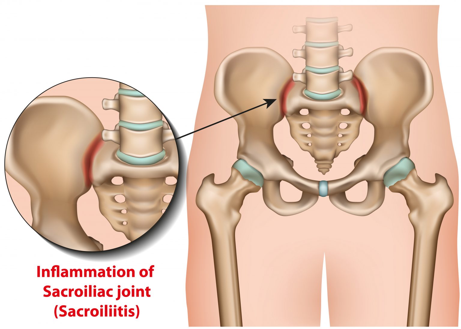 sacroiliac-joint-inflammation-3d-medical-vector-illustration